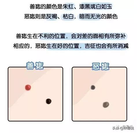 肚臍裡有痣